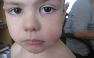 У ребенка болят щеки и высокая температура